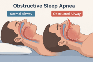 Obstructive sleep Apnea