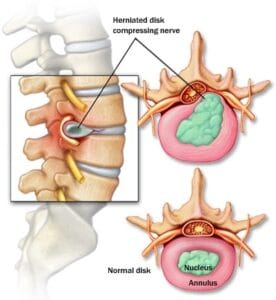 Herniated disc