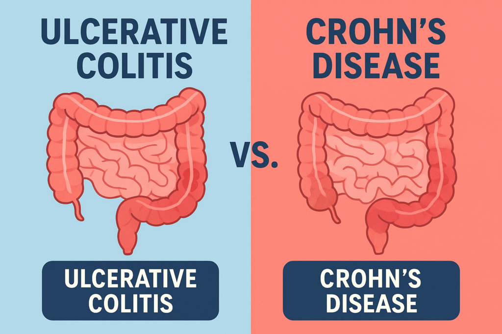 Ulcerative Colitis vs Crohn’s Disease 11 Key Differences You Must Know