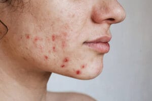 acne vulgaris