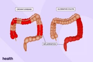 ulcerative colitis vs Crohn’s disease