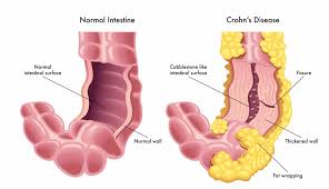ulcerative colitis vs Crohn’s disease