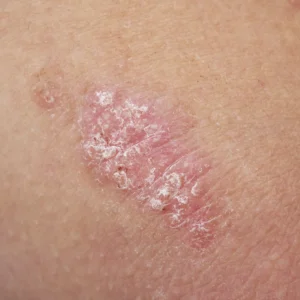 psoriasis; zinc deficiency and skin health