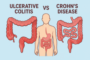 ulcerative colitis vs Crohn’s disease