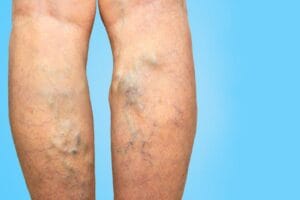 varicose vein