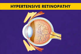 Hypertensive retinopathy