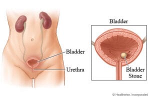 bladder stone