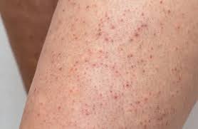 Keratosis Pilaris: