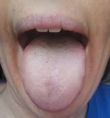 Pale Tongue