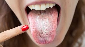 White Patches on Tongue