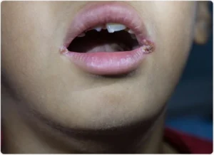 angular cheilitis or stomatitis