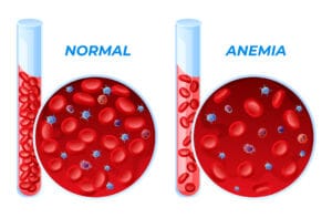 anaemia
