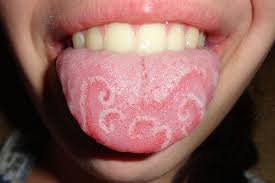 Geographic Tongue