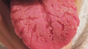 cracked tongue